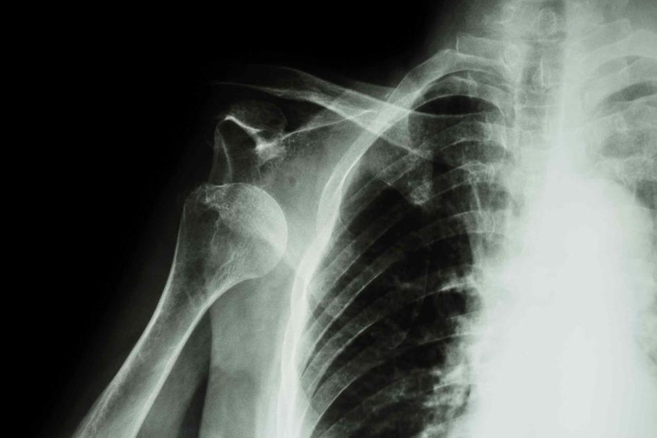 Prolotherapy Heal Shoulder Injuries